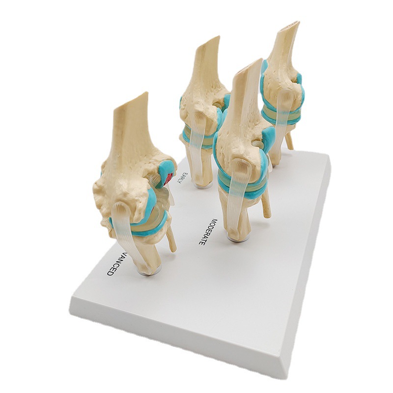 Medical College human bone anatomical normal lesions 4 stage knee model