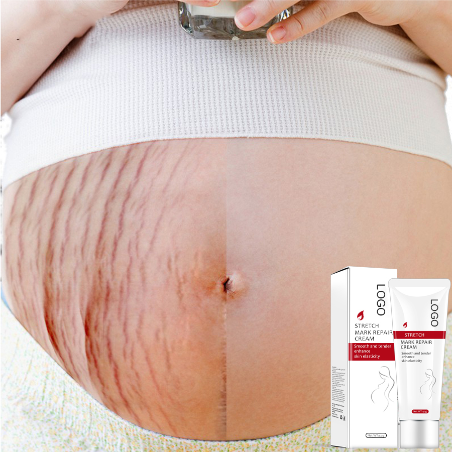 Wholesale Stretch Mark Cream Anti Vergeture Creme Pregnancy Scars Treatment Lotion Skin Care Natural Stretch Mark Removal Cream