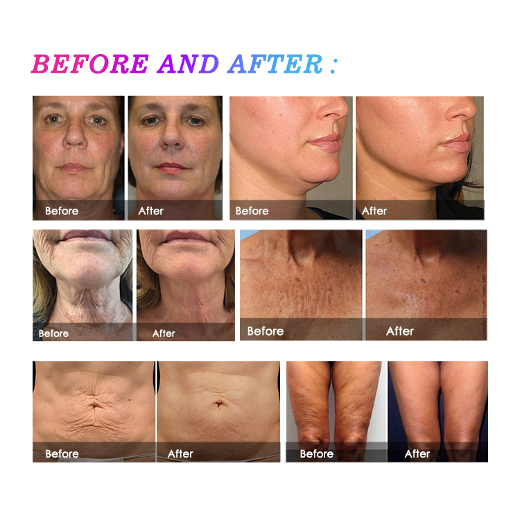 KES newest shots 4D HIFU machine factory price for wrinkle removal facial lifting body slimming