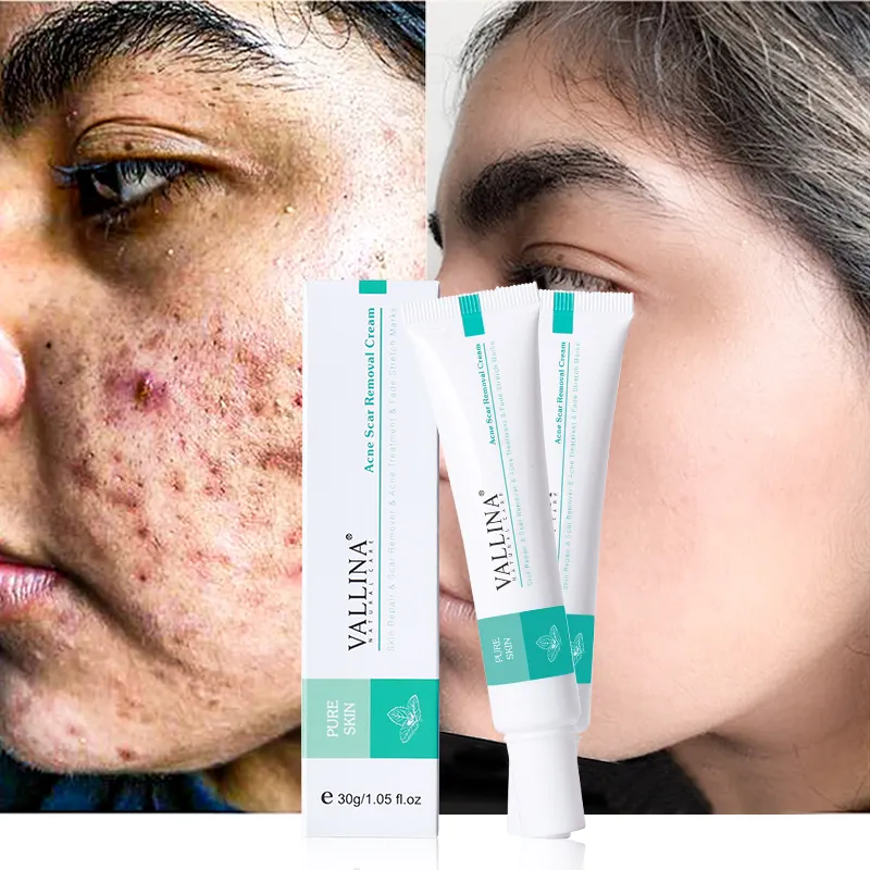 30g OEM/ODM anti acne cream Pimple acne Moisturizer Acne Scar Treatment Cream