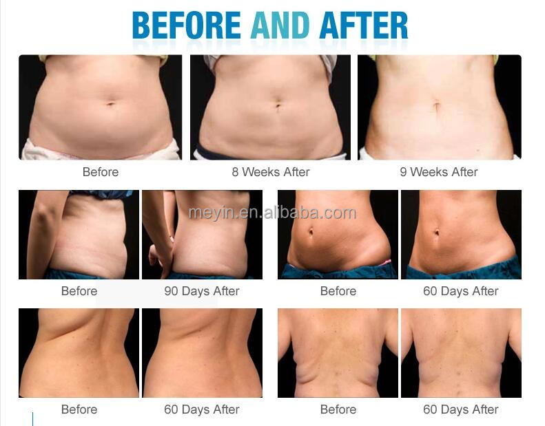 Cryolipolysis spare parts the fat freezing handpieces /cryolipolysis 360 double chin handle