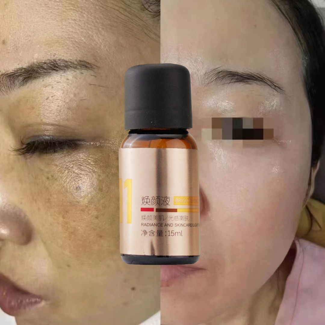 OEM Melasma Peel blemish with salicylic acid Dark spot correction skin aqua Peeling solution Chemical Peel for face professional