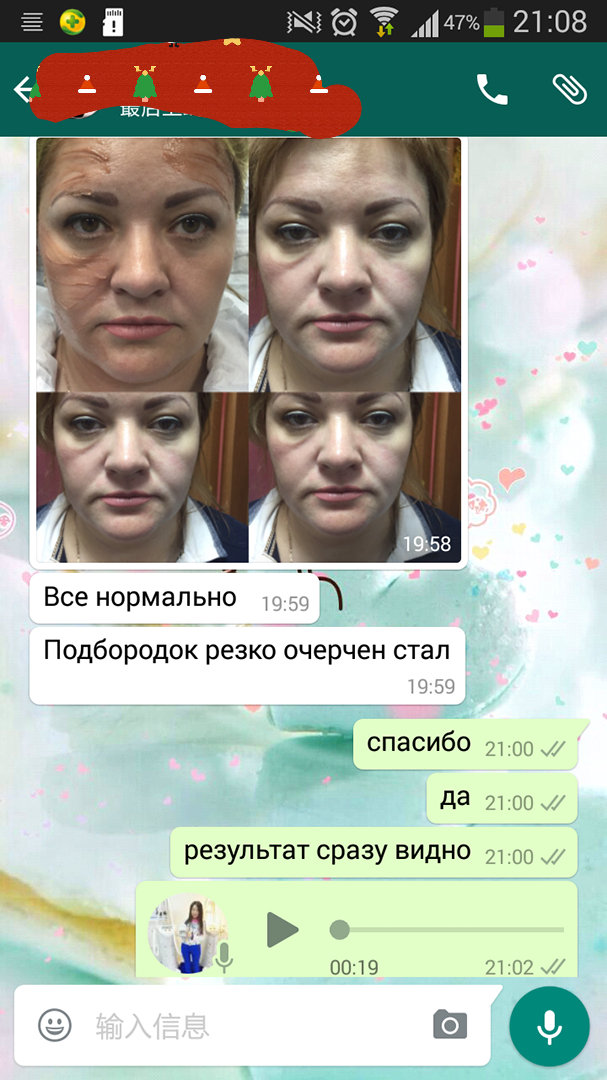 Профессиональная подъемная машина hifu vmax для лифтинга и лифтинга тела 4 в 1 smas 2020 на продажу Monaliza Spot в России
