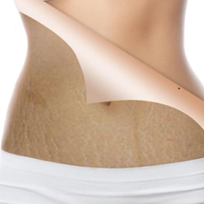 100% Natural Snail Stretch Mark Treatment Cream Without Side Effect