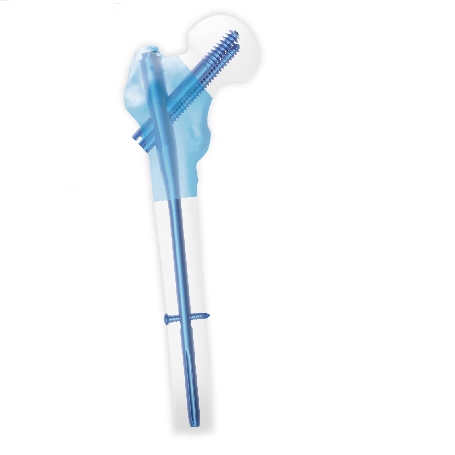 Intertan femor nail surgeri proximal femoral intramedullary nail implants