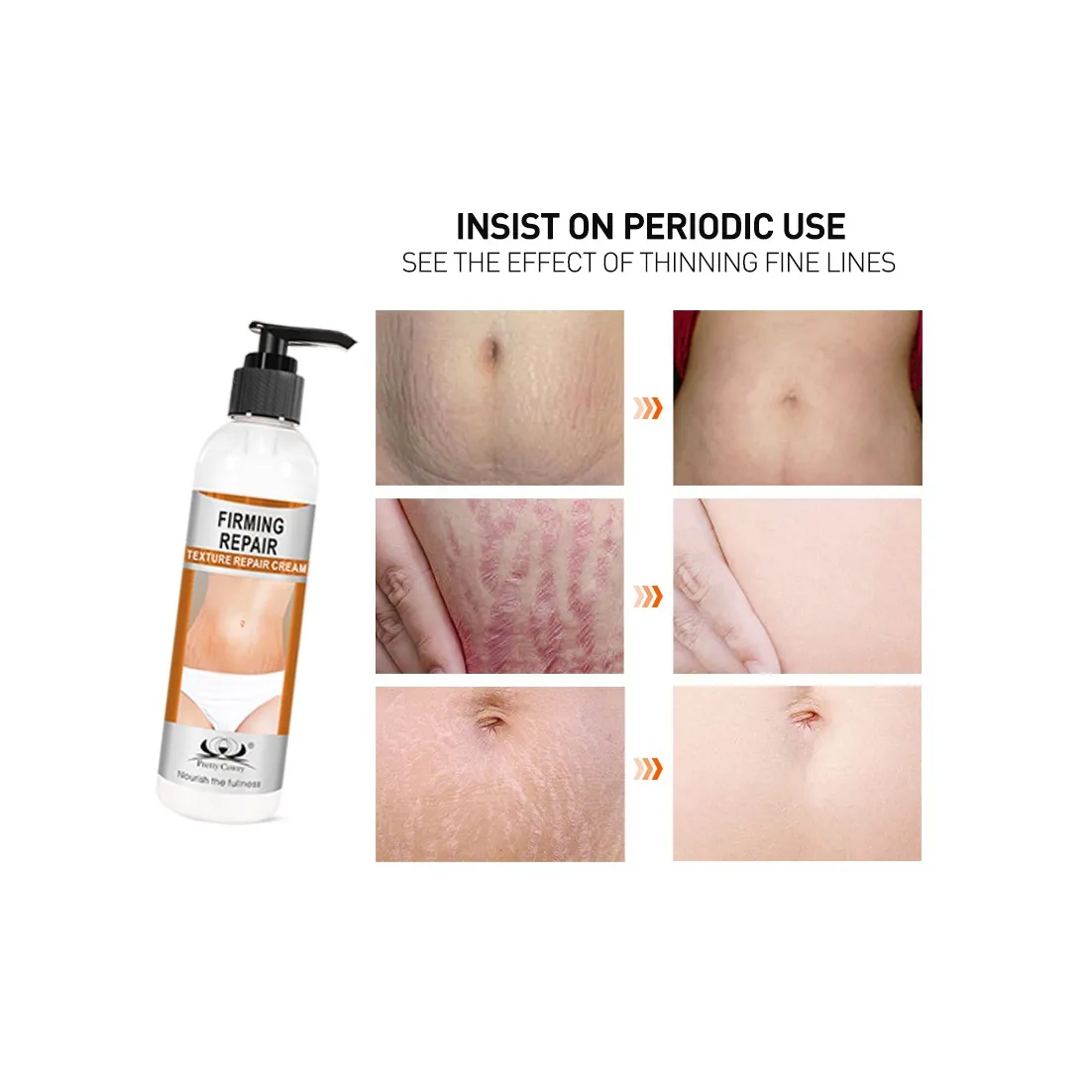 High Quality And Low Price Private Label Stretch Mark Cream Stretch Marks Removal Cream