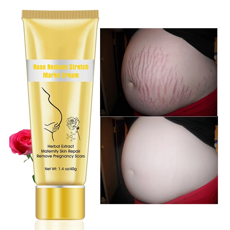 Skin Care Best Effective Mango Pregnancy For Marks Private Label Anti Lanbena Repair Stretch Mark Removal Cream