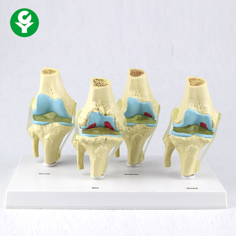 Four Stage Pathological Knee Joint Model Medical Science Anatomical Skeleton