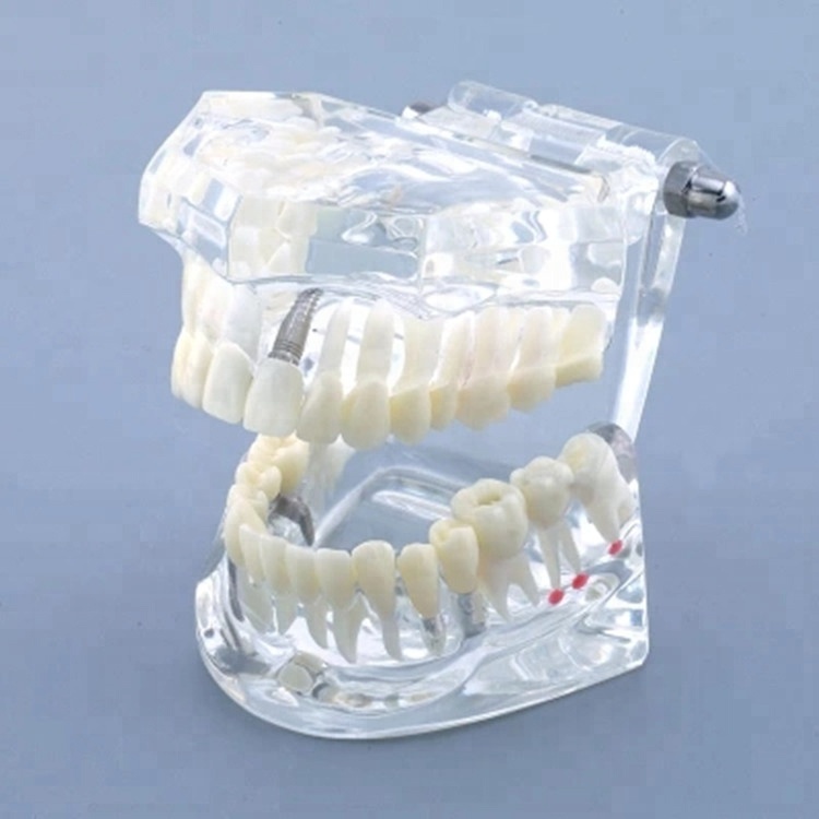 [AiFan Dental] Alibaba китайский поставщик ZYR-2001 имплантатная Учебная модель для стоматологов