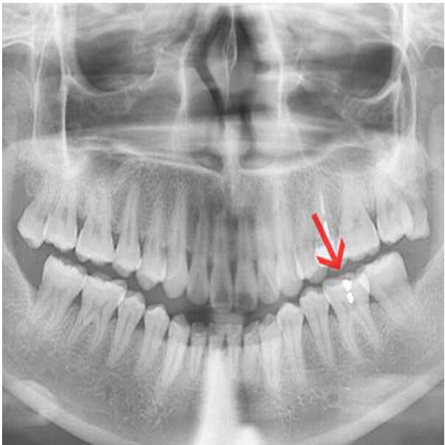 Цифровая рентгенографическая пленка fuji x ray 8x10 10x14 14x17