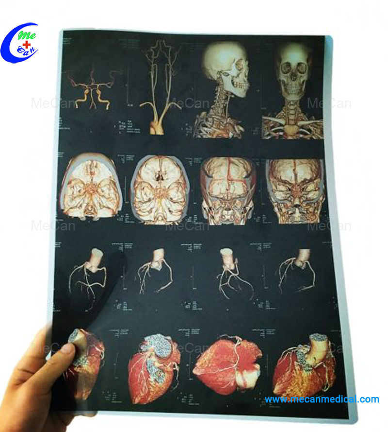 Radiology медицинская сухая струйная рентгеновская пленка для больничного пленочного принтера