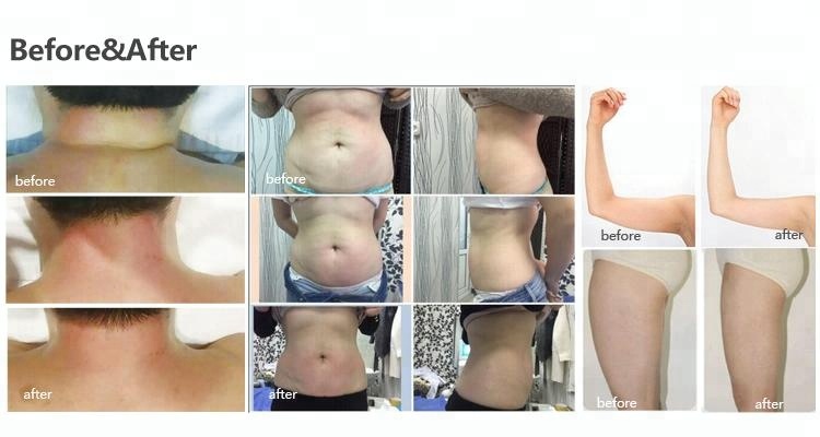 Кавитация + RF + вакуумная машина для похудения