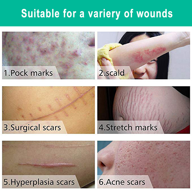Stretch Mark Cream for Pregnancy   Scar Removal stretch marks scar removal cream Maternity treatment