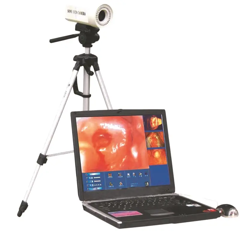 medical diagnosis equipment digital laptop Gynecology Electronic Colposcope