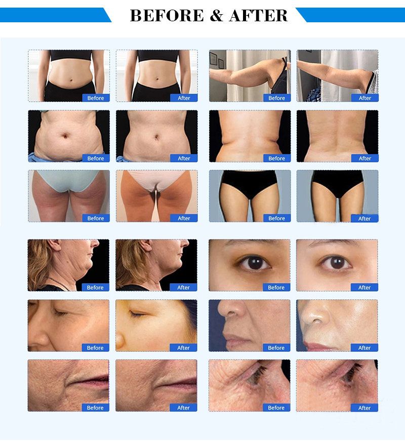 6 в 1 RF Lipolaser 80k кавитации 40k кавитации Lipolaser RF Ультразвуковая уменьшая кавитацию машины