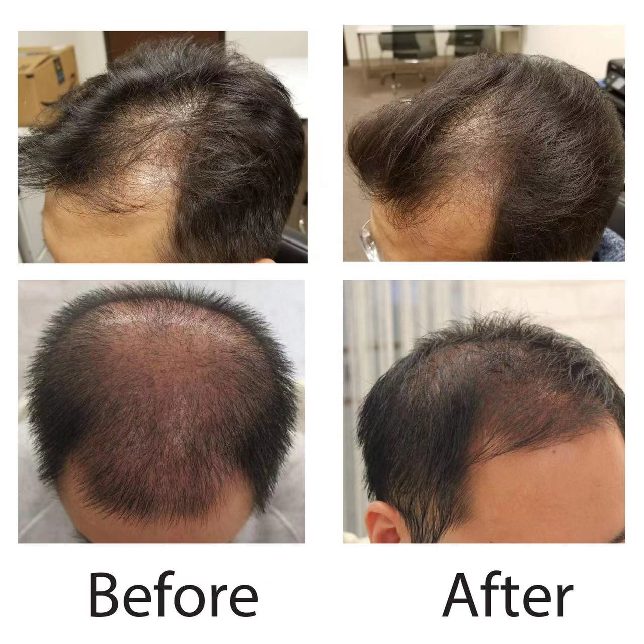 LLLT medical laser helmet 108/200/266 272 diodes cap for hair growth Laser Diode Care Loss Treatment