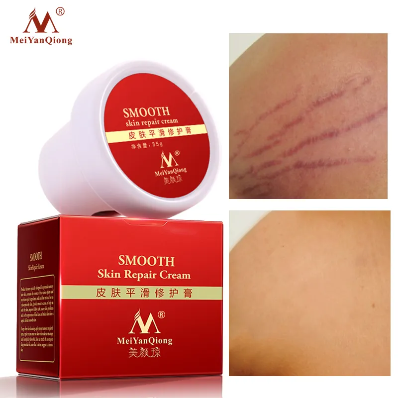 Anti Maternity treatment stretch marks scar removal cream Pregnancy Scar Removal Stretch Mark Cream