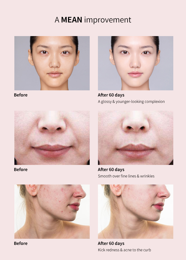 Customized beauty mask with 3 colors light therapy anti acne led therapy beauty face mask