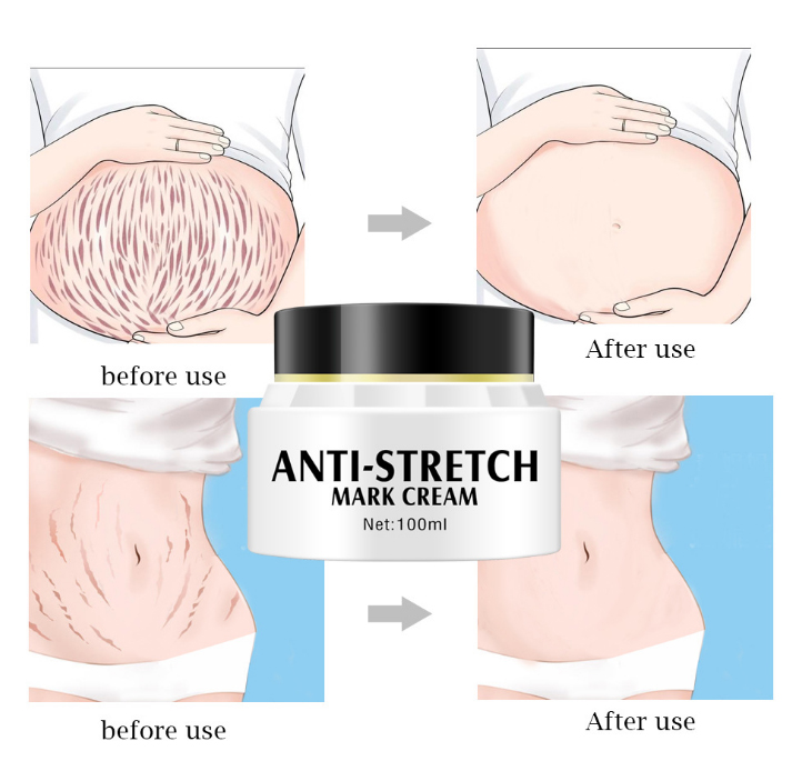Hot Sales 3 Days Effective Private Label Natural Organic Body Care Deep Acne Scar Anti Stretch Mark Removal Cream