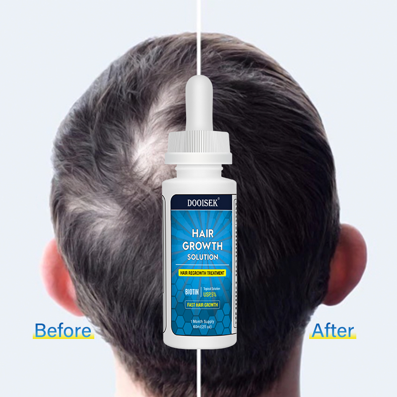 Private Label High quality fast hair growth serum hair regrowth treatment product for men hair growth