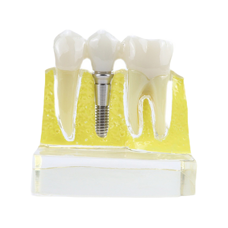 Dental Implant Model/Dental Teaching Model/Dental Removable Teeth Implant Model