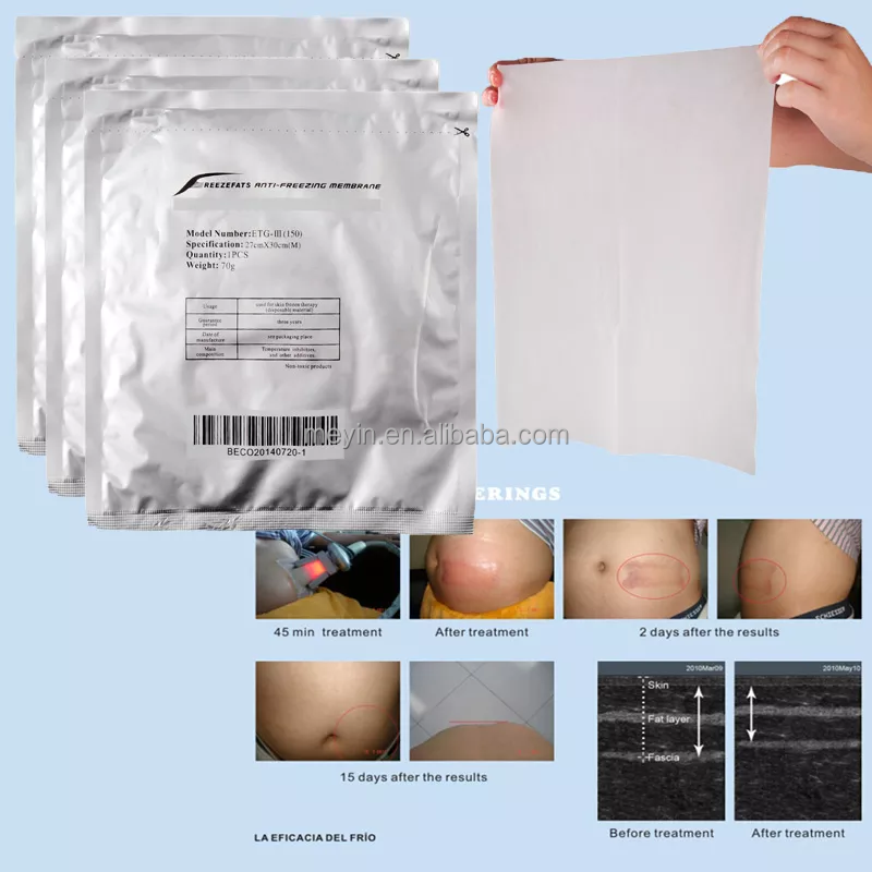 antifreeze membranes criolipolisis cryolipolysis antifreeze membrane