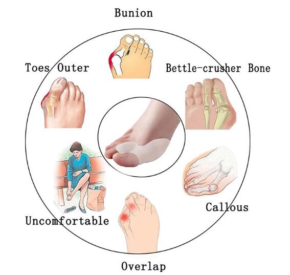 Гель-сепаратор для ног Bunion Hallux Valgus