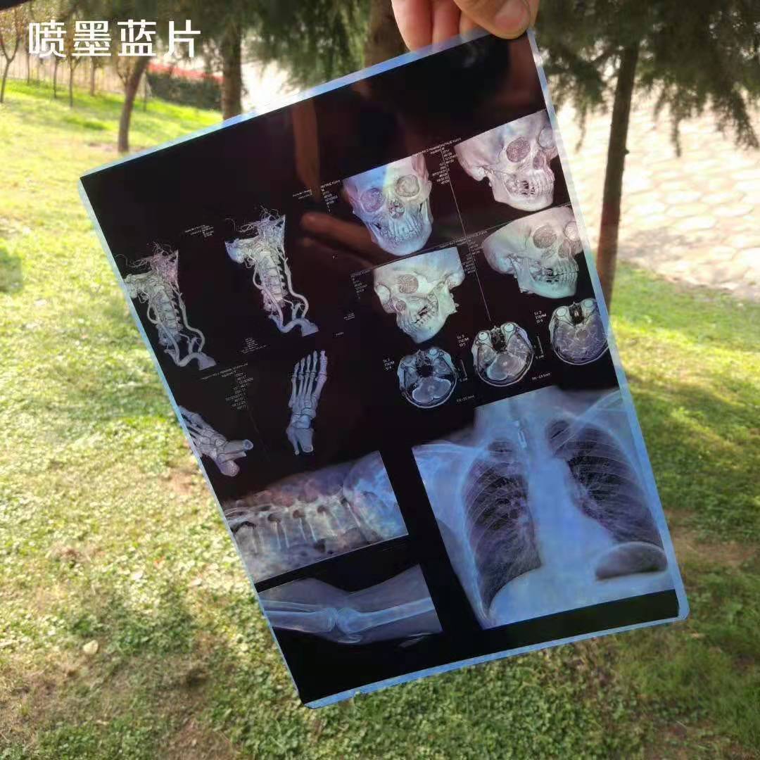 Медицинская сухая пленка A4/A3 Blue Xray сухая ПЭТ для струйной печати медицинская пленка Высокая острота