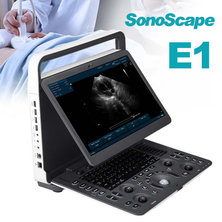 Sonoscape e1 exp ultrasonido sonoscape b/w ultrasound machine price /Portable ultrasound scanner