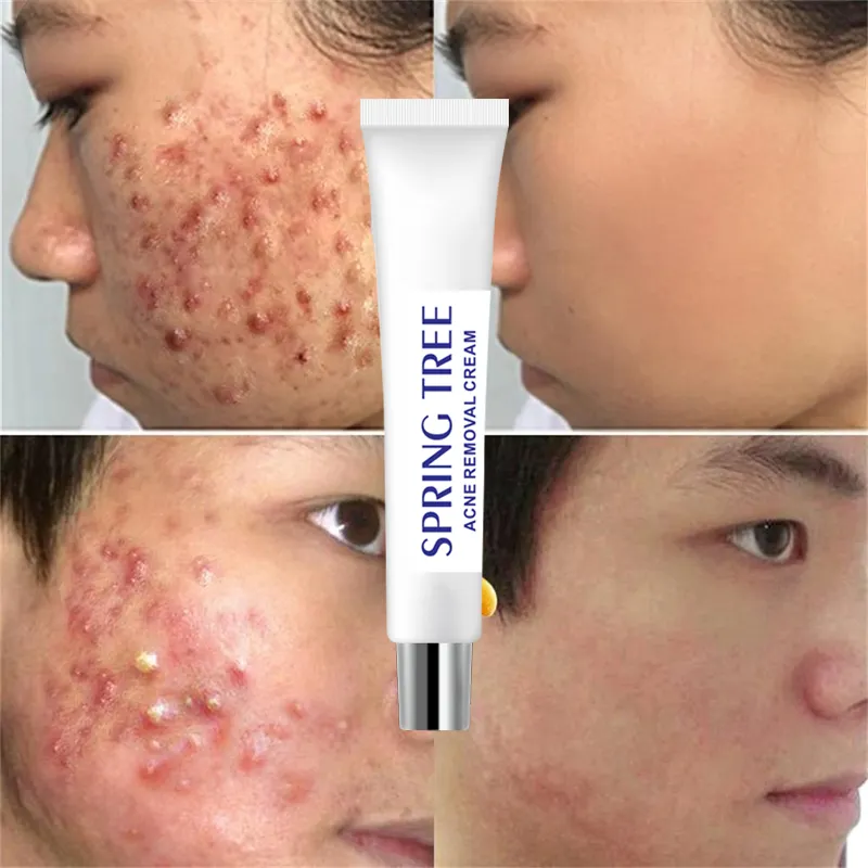 Quick acne pimples care scar treatment spot removal anti acne herbal cream