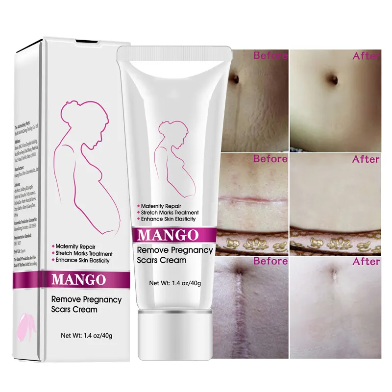 OEM best effective stretch mark removal cream mango pregnancy for marks private label anti lanbena repair stretch mark cream