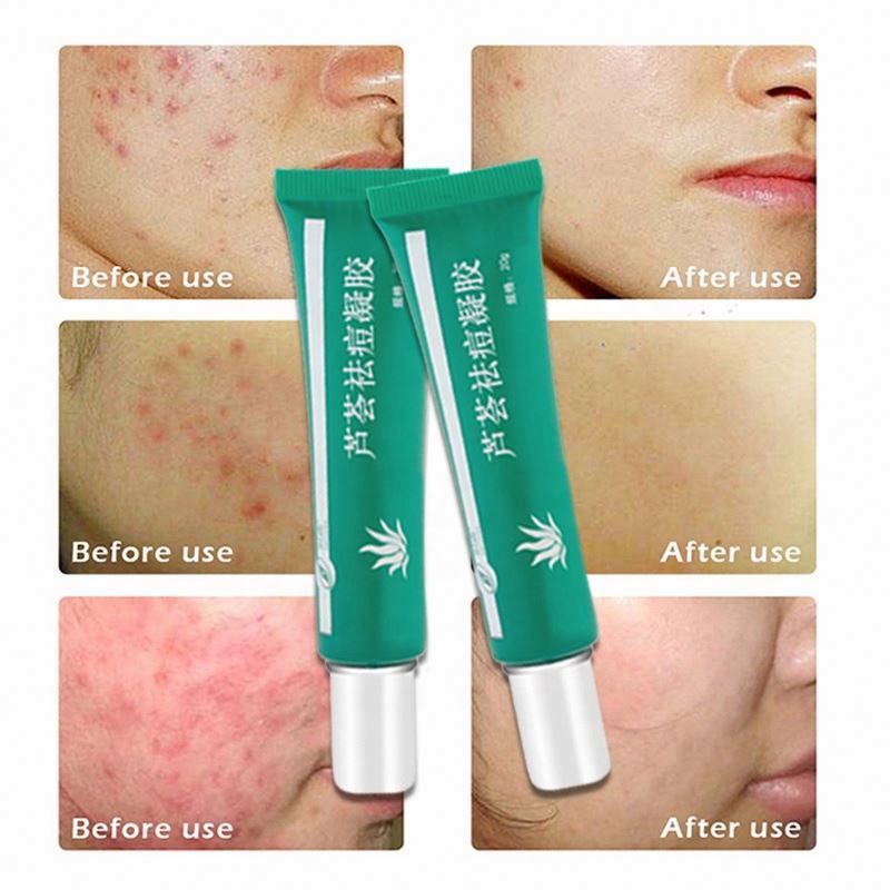 L aloe vera help with acne be used as moisturizer cure pimples