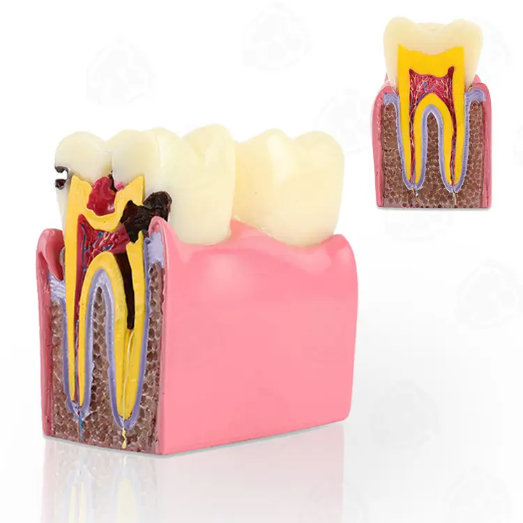 Dental Study 6 Times Tooth Decay 2 Side Anatomical Contrast Cross Section Bilateral Comparison Caries Teeth Model