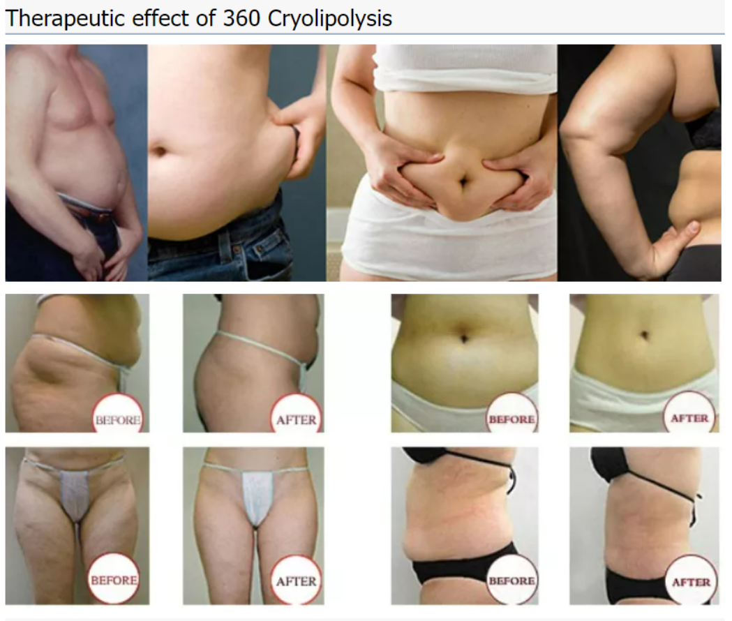 Cryo machine cryofacial fat freeze cryolipolysis machine 40k cavitation 650nm lipo laser fat slimming machine for sale