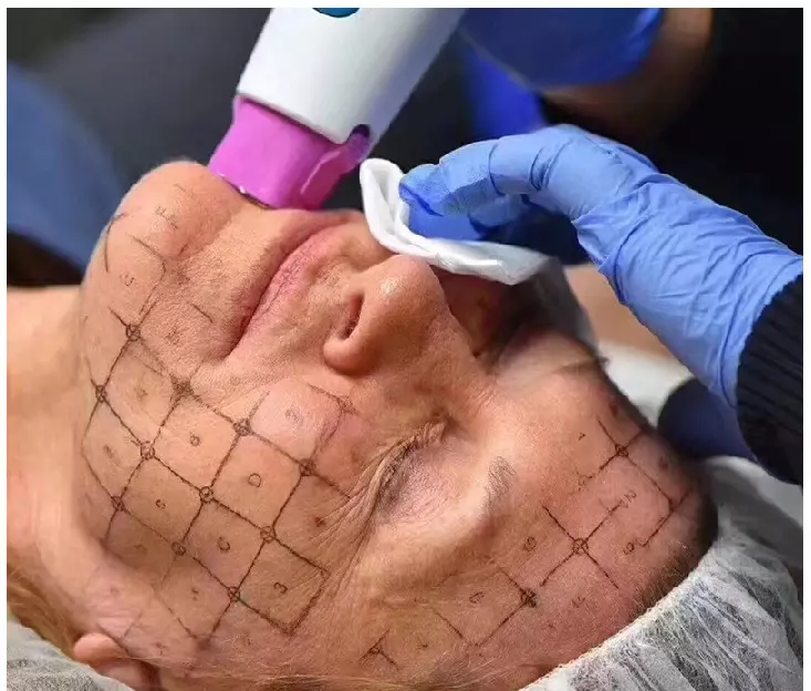 2020 устройство aprobado body thermagic novo Ultimate