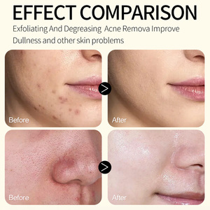 Limpiador Facial Antiacné <span class=keywords><strong>de</strong></span> Marca Privada, Control <span class=keywords><strong>de</strong></span> Grasa, <span class=keywords><strong>Limpieza</strong></span> Profunda, para Piel Grasa y Propensa al Acné - Product Image 4