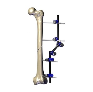 Nuevo Sistema de Fijación Externa de Fémur Médico Profesional de Primera Calidad, Venta Caliente 2025, Juego de Instrumentos Personalizados de 8 mm - Product Image 3