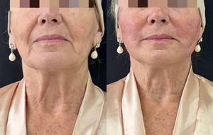 Équipement de diode laser 980nm 1470nm Endolifting liposuccion Laser beauté peau amincissant la machine - Product Image 3
