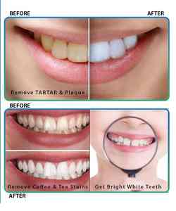 Juego de cuidado dental, limpieza de dientes, removedor de sarro, uso de mascotas, sonda dental, espejo bucal, escalador M/O, acero inoxidable de alta calidad - Product Image 6