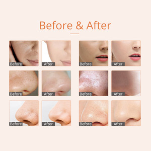 ダイヤモンド皮膚剥離マイクロ皮膚剥離ブラックヘッド除去真空孔洗浄機MS-33P3 - Product Image 5