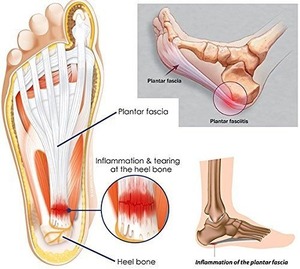 Protector de Talón de Gel de Silicona, Amortiguador de Impactos para Fascitis Plantar, Espolones Calcáneos, Dolor de Pies y Talones Agrietados - Product Image 5