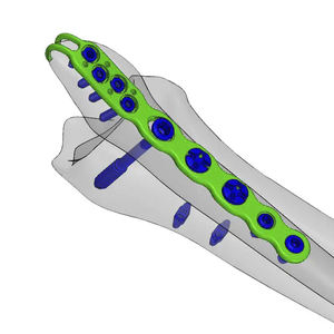 Plaque de compression fibulaire, plaque de reconstruction, 3,5/4,0 mm, plaque osseuse en acier inoxydable, instruments CE - Product Image 3