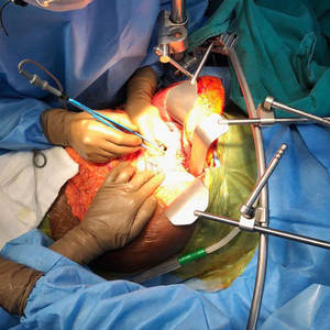 Système d'écarteur Thompson greffe de foie Instruments chirurgicaux Ensemble d'écarteur Thompson de qualité à vendre - Product Image 6