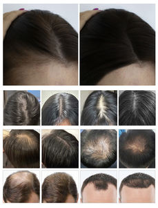 Appareil professionnel de repousse des cheveux par diode à faible puissance 650nm 660nm pour massage capillaire et beauté, idéal pour les salons - Product Image 4