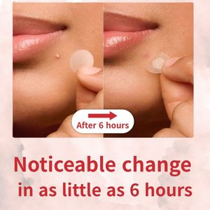 Parches para el Acné PimplePatch, Tratamiento Orgánico con Hidrocoloide, Puntos Curativos Hipoalergénicos, Parche Facial Invisible - Product Image 6