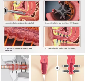 Máquina de medicina estética láser de diodo de terapia ginecológica de longitud de onda dual de 980nm y 1470nm <span class=keywords><strong>para</strong></span> rejuvenecimiento y ajuste vaginal - Product Image 4