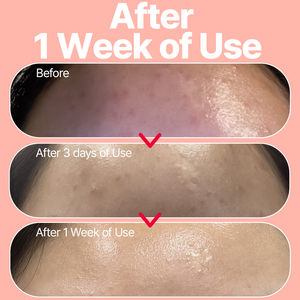 ATOMU ACLIS suero patentado solución para el acné suero hidratante calmante para pieles sensibles y con problemas piel revitalizante antienvejecimiento - Product Image 6