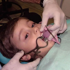 Professional <b>Dental</b> <b>Mouth</b> Gag Stainless Steel Surgical <b>Mouth</b> <b>Opener</b> with Lip Retractor Electro Coating Manual Power Source - Product Image 5