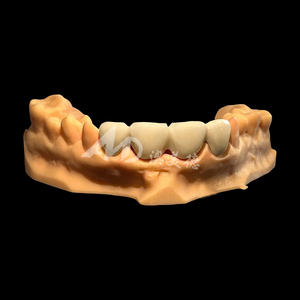 Pont <span class=keywords><strong>dentaire</strong></span> PFM : Conçu avec l'expertise <span class=keywords><strong>dentaire</strong></span>, conçu pour un confort durable - Product Image 6