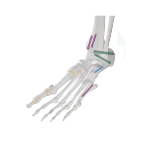 Tornillo Pedicular Ortopédico Manual de Acero Inoxidable 2025 para Cirugía de Columna Vertebral Veterinaria - Product Image 6